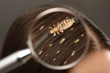 image showing head lice on scalp